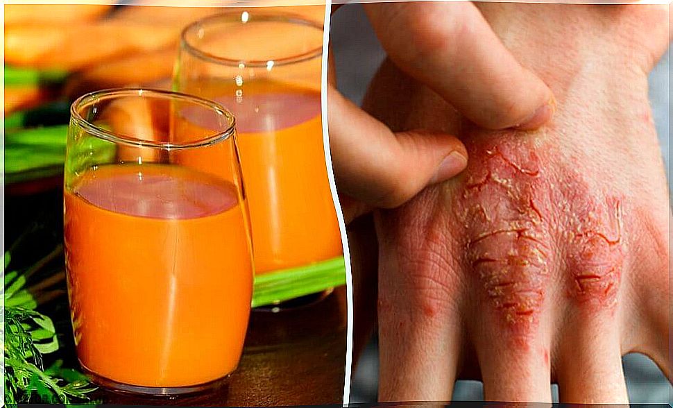 Treatment of psoriasis - 7 home remedies