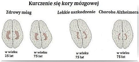 Alzheimer's - Recognize the Early Signals