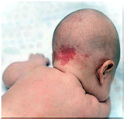 Birthmarks and spots from birth: why do they appear?