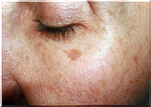 Skin spots