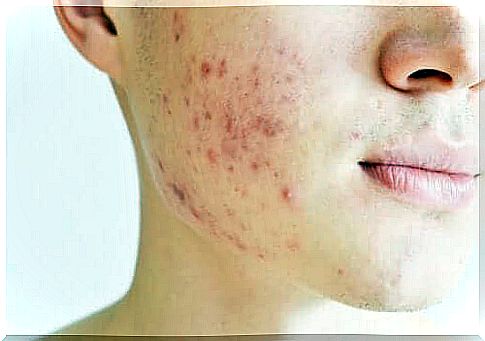 Cystic acne: an aggressive form of acne