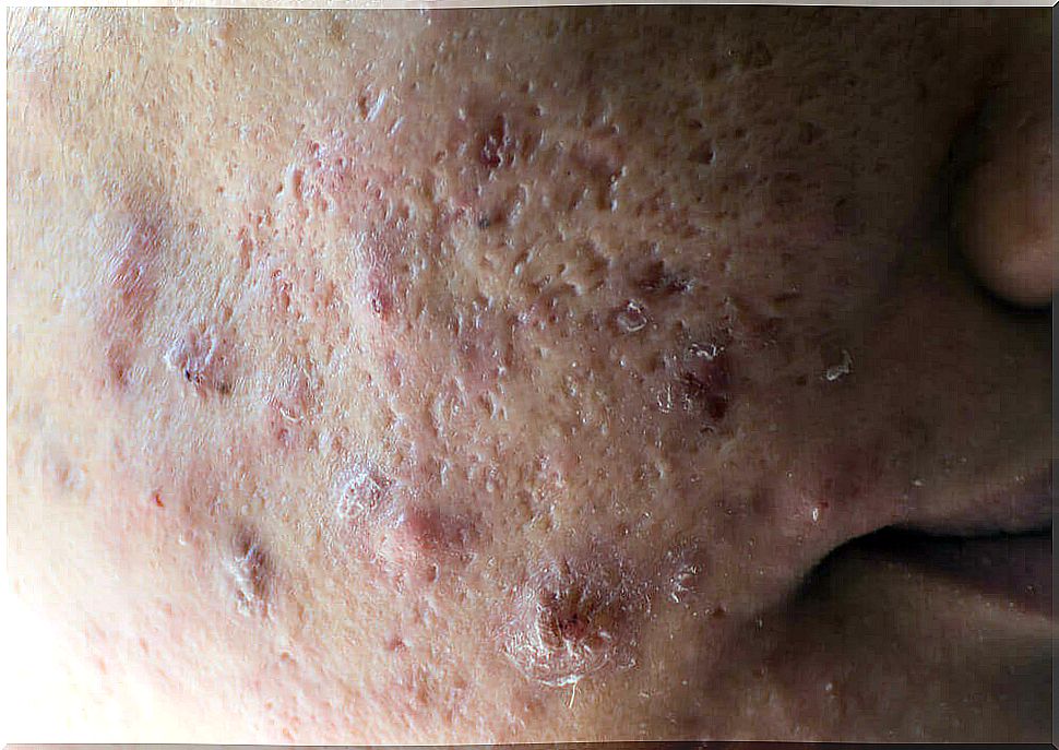 Cystic acne - the most aggressive type of acne