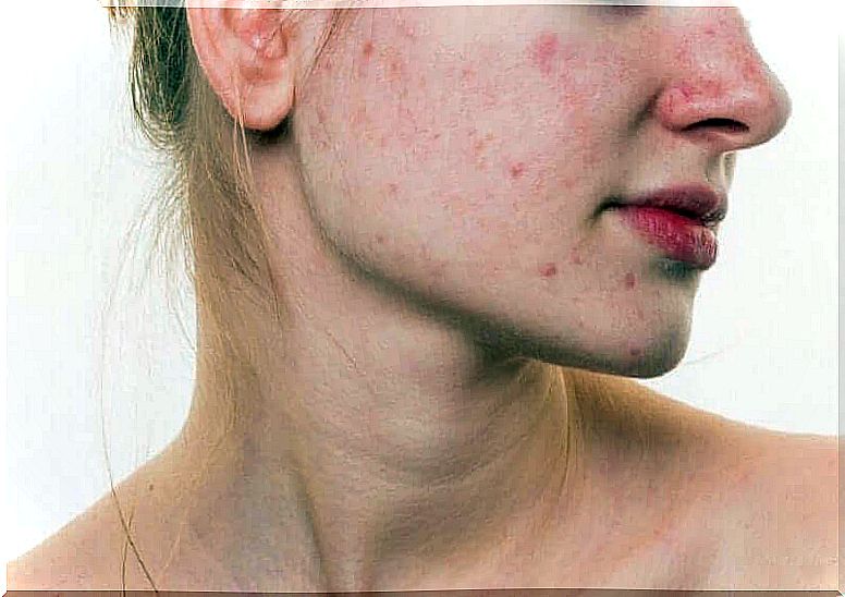 Acne on the cheek