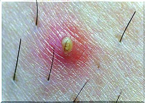 ingrown hair