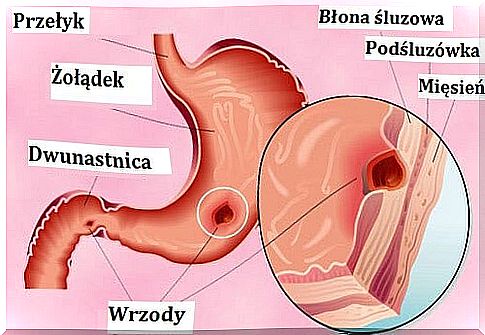 Stomach ulcers