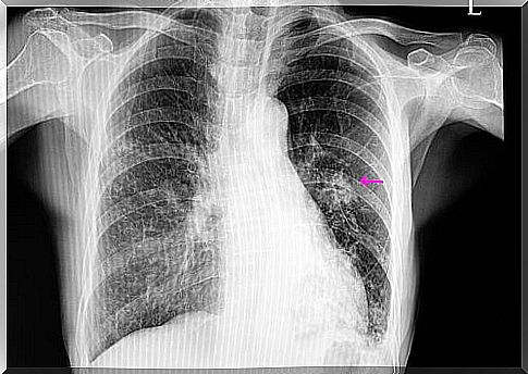 A pulmonary nodule, what is it and how does it arise?