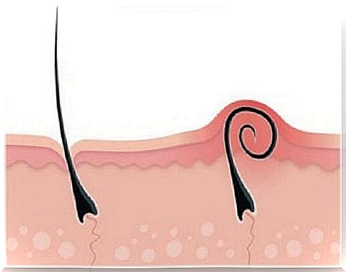 Ingrown hair?  - There are ways