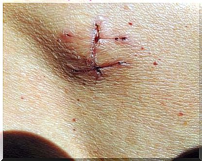 Sutures after hernia surgery