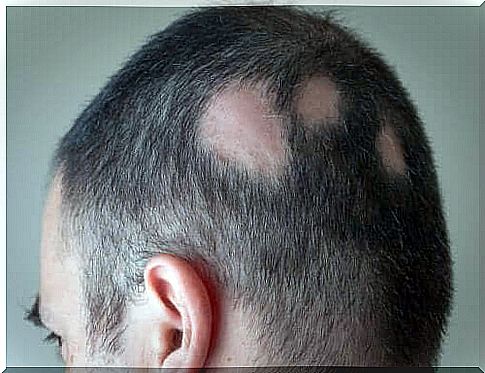 Minoxidil for alopecia