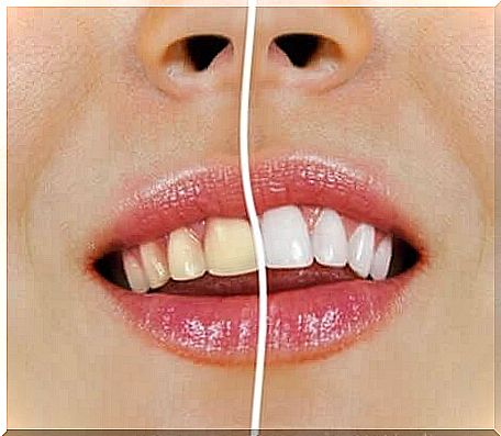 White and yellow teeth - natural methods of teeth whitening