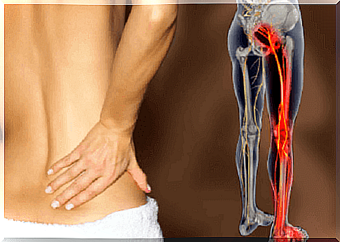 Sciatica - natural treatments