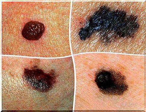 Melanoma