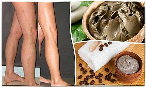 Varicose veins - 5 natural ways to fight them