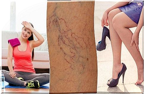 Venous spider veins - 8 methods of prevention